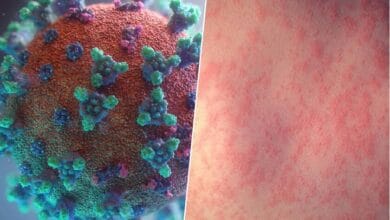 Ilustración del virus del sarampión