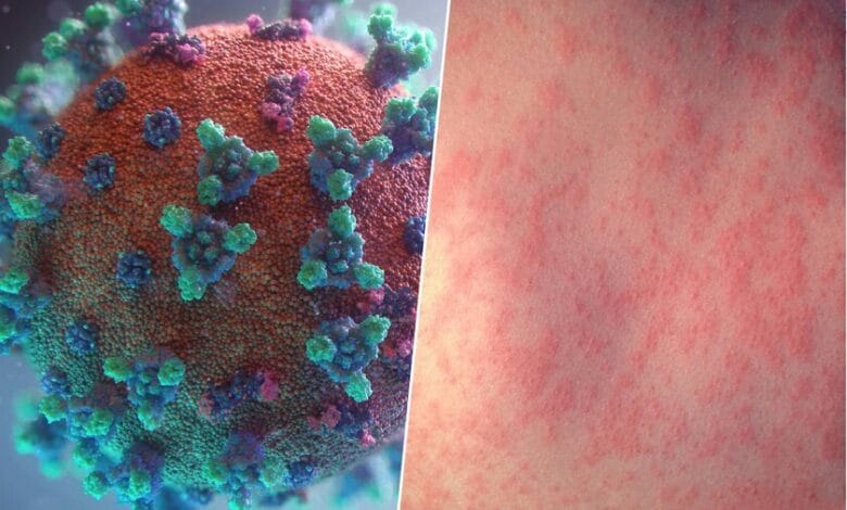 Ilustración del virus del sarampión