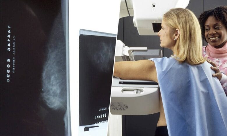 Mamografía con IA