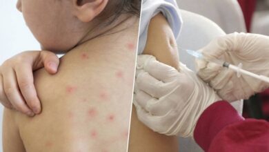 Imagen de un niño con sarampión