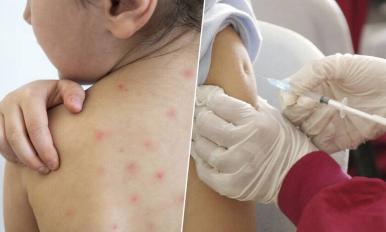 Imagen de un niño con sarampión, con manchas rojas en la piel