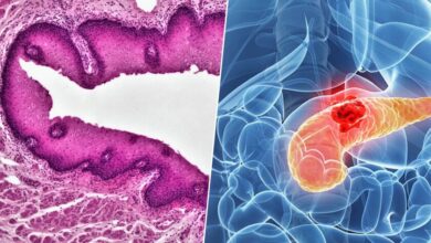 Ilustración del cáncer de páncreas y su tratamiento experimental