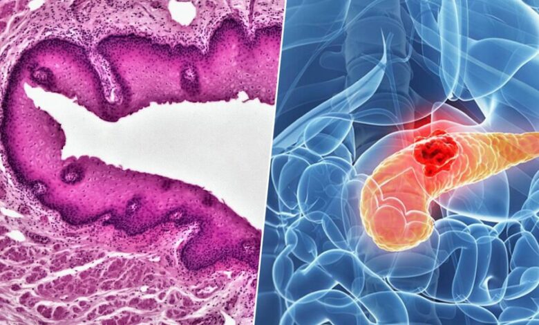 Ilustración del cáncer de páncreas y su tratamiento experimental