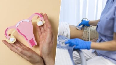 Mujer con síntomas del Síndrome de Ovario Poliquístico