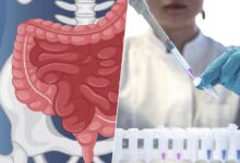 Imagen de un médico explicando sobre el cáncer de colon