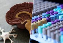 Imagen de un cerebro humano con una zona afectada por el alzhéimer
