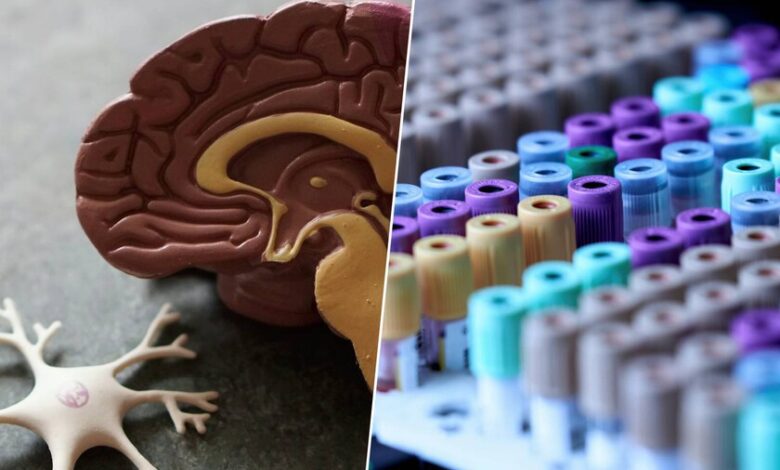 Imagen de un cerebro humano con una zona afectada por el alzhéimer