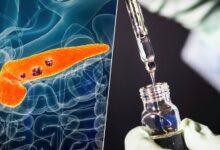 Imagen de un paciente con cáncer de páncreas