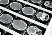 Cerebro saludable y envejecimiento cerebral