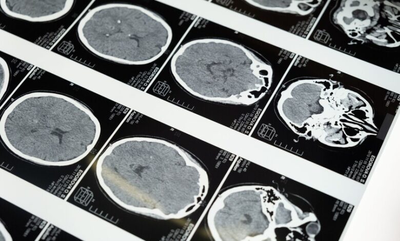 Cerebro saludable y envejecimiento cerebral
