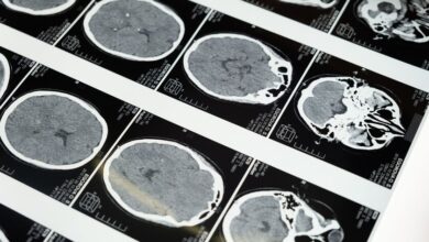 Ilustración de un cerebro saludable